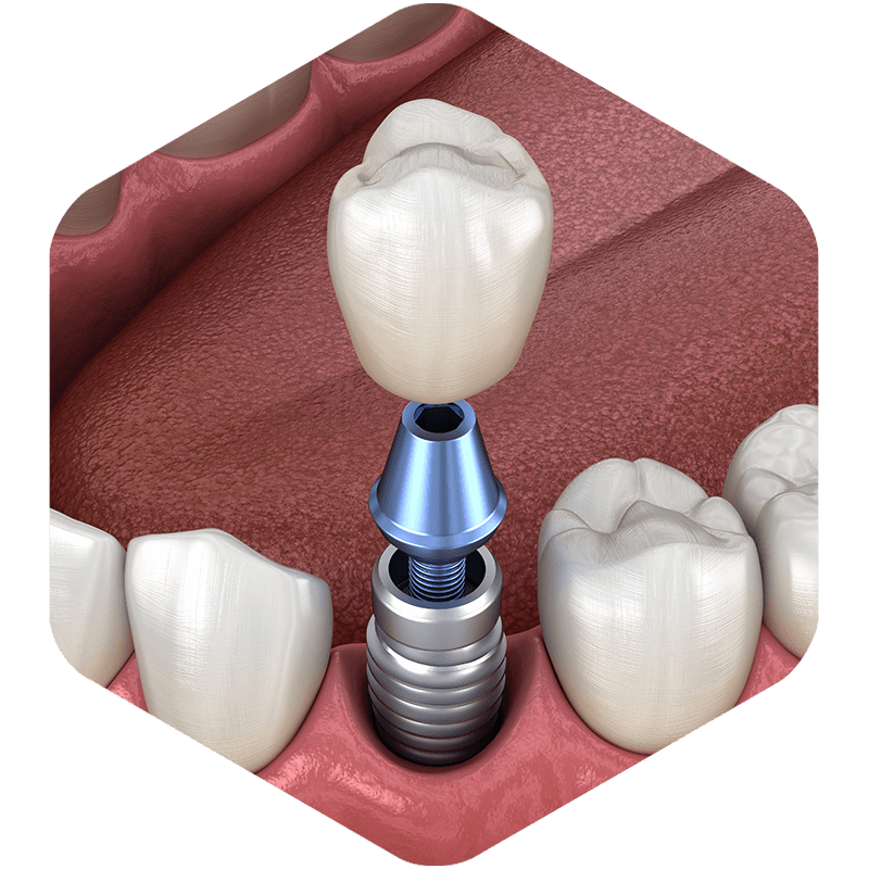 3D illustration of a dental implant with its crown.